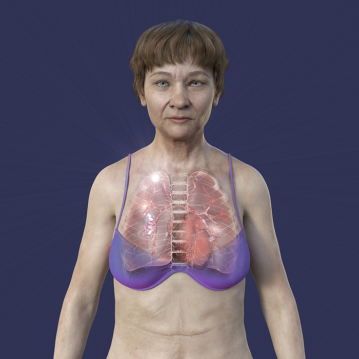 Woman with apical tuberculosis, illustration Illustration of a woman with lungs affected by apical tuberculosis., by KATERYNA KON SCIENCE PHOTO LIBRARY