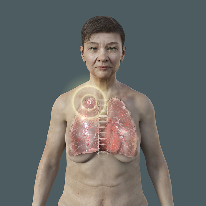 Woman with apical tuberculosis, illustration Illustration of a woman with lungs affected by apical tuberculosis., by KATERYNA KON SCIENCE PHOTO LIBRARY