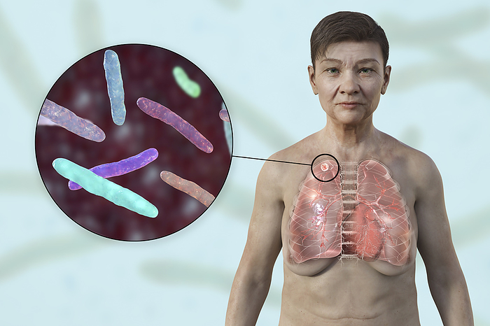 Woman with apical tuberculosis, illustration Illustration of a woman with lungs affected by apical tuberculosis and a close up of Mycobacterium tuberculosis bacteria., by KATERYNA KON SCIENCE PHOTO LIBRARY