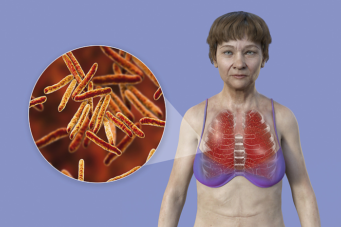Woman with lung miliary tuberculosis, illustration Illustration showing a female patient with transparent skin, revealing the lungs affected by miliary tuberculosis and close up of Mycobacterium tuberculosis bacteria., by KATERYNA KON SCIENCE PHOTO LIBRARY