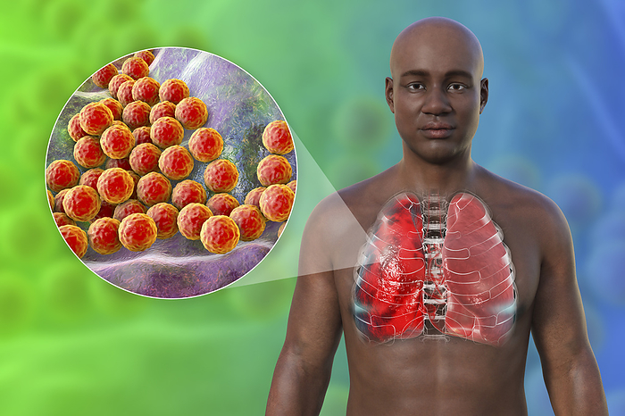 Man with lungs affected by pneumonia, illustration Illustration showing the upper half of a man with transparent skin, revealing the lungs affected by pneumonia, and close up of Staphylococcus aureus bacteria., by KATERYNA KON SCIENCE PHOTO LIBRARY