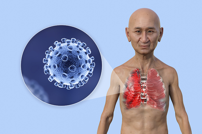 Man with lungs affected by Covid 19 pneumonia, illustration Illustration showing the upper half of a man with transparent skin, revealing the lungs affected by Covid 19 pneumonia, and close up of SARS CoV 2 viruses., by KATERYNA KON SCIENCE PHOTO LIBRARY