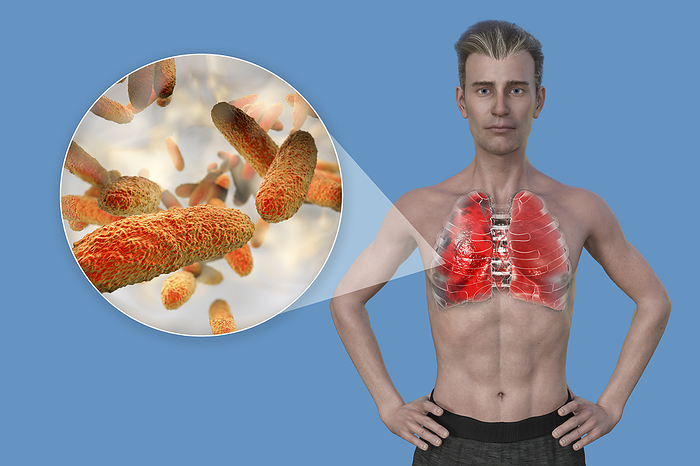 Man with lungs affected by pneumonia, illustration Illustration showing the upper half of a man with transparent skin, revealing the lungs affected by pneumonia, and close up of Klebsiella pneumoniae bacteria., by KATERYNA KON SCIENCE PHOTO LIBRARY