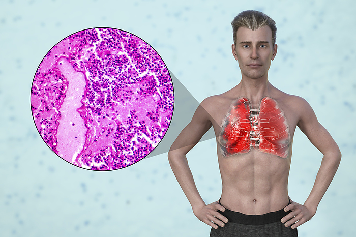 Man with lungs affected by pneumonia, illustration Illustration showing the upper half of a man with transparent skin, revealing the lungs affected by pneumonia, along with a micrograph of pneumonia., by KATERYNA KON SCIENCE PHOTO LIBRARY