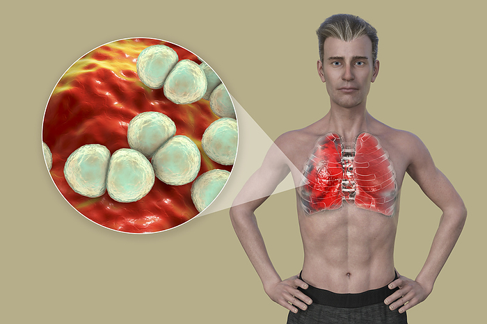 Man with lungs affected by pneumonia, illustration Illustration showing the upper half of a man with transparent skin, revealing the lungs affected by pneumonia, and close up of Streptococcus pneumoniae bacteria., by KATERYNA KON SCIENCE PHOTO LIBRARY