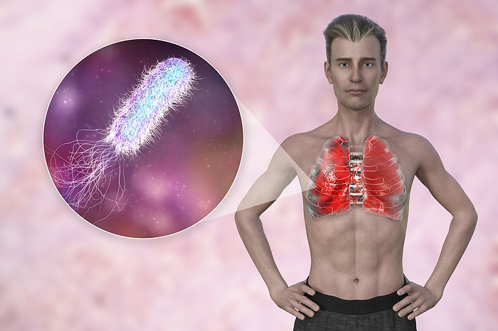 Man with lungs affected by pneumonia, illustration Illustration showing the upper half of a man with transparent skin, revealing the lungs affected by pneumonia, and close up of Pseudomonas aeruginosa bacteria., by KATERYNA KON SCIENCE PHOTO LIBRARY