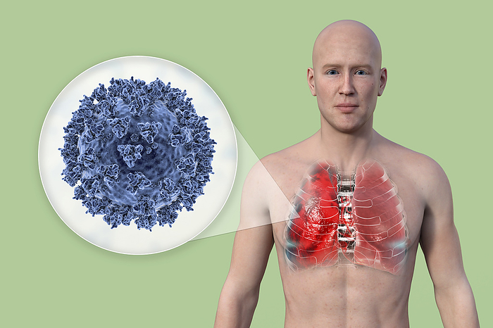 Man with lungs affected by Covid 19 pneumonia, illustration Illustration showing the upper half of a man with transparent skin, revealing the lungs affected by Covid 19 pneumonia, and close up of SARS CoV 2 viruses., by KATERYNA KON SCIENCE PHOTO LIBRARY