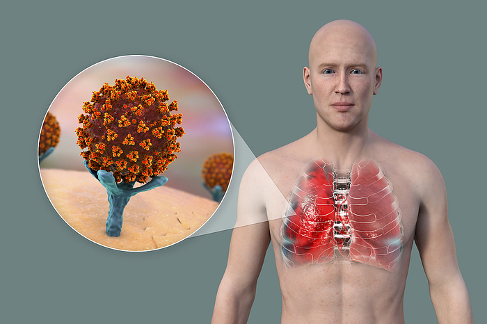 Man with lungs affected by Covid 19 pneumonia, illustration Illustration showing the upper half of a man with transparent skin, revealing the lungs affected by Covid 19 pneumonia, and close up of SARS CoV 2 viruses binding cell receptors., by KATERYNA KON SCIENCE PHOTO LIBRARY