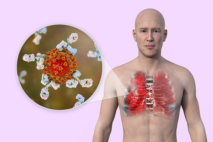 Man with lungs affected by Covid 19 pneumonia, illustration Illustration showing the upper half of a man with transparent skin, revealing the lungs affected by Covid 19 pneumonia, and close up of SARS CoV 2 viruses surrounded by antibodies., by KATERYNA KON SCIENCE PHOTO LIBRARY