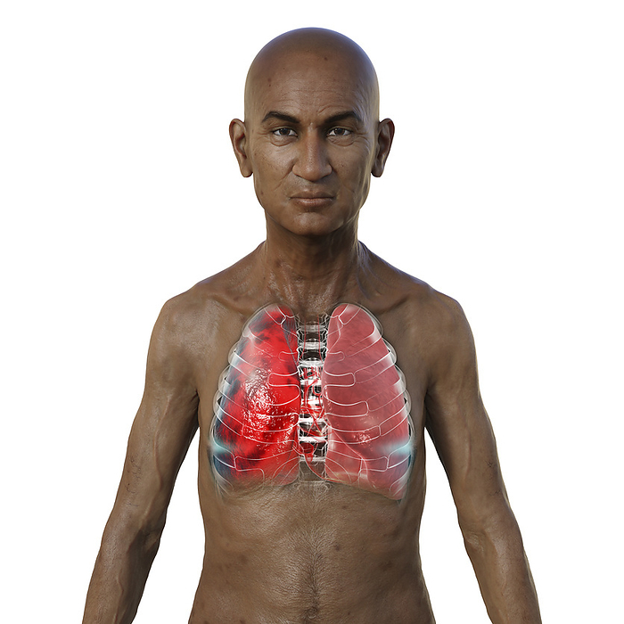 Man with lungs affected by pneumonia, illustration Illustration showing the upper half of a man with transparent skin, revealing the lungs affected by pneumonia., by KATERYNA KON SCIENCE PHOTO LIBRARY