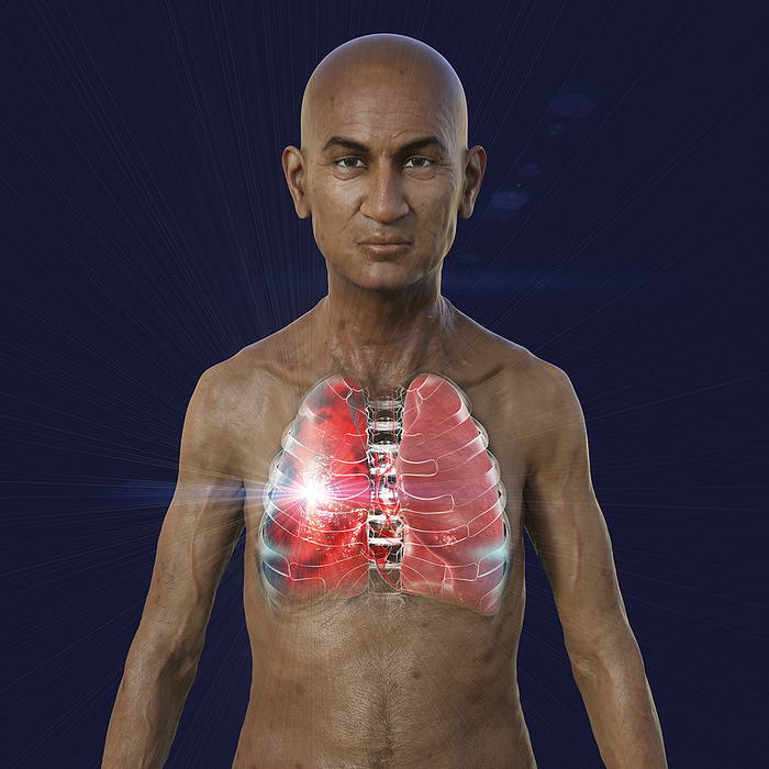 Man with lungs affected by pneumonia, illustration Illustration showing the upper half of a man with transparent skin, revealing the lungs affected by pneumonia., by KATERYNA KON SCIENCE PHOTO LIBRARY