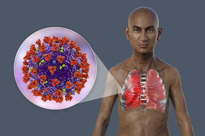 Man with lungs affected by pneumonia, illustration Illustration showing the upper half of a man with transparent skin, revealing the lungs affected by Covid 19 pneumonia, and close up of SARS CoV 2 viruses., by KATERYNA KON SCIENCE PHOTO LIBRARY