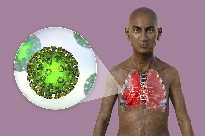 Man with lungs affected by pneumonia, illustration Illustration showing the upper half of a man with transparent skin, revealing the lungs affected by Covid 19 pneumonia, and close up of SARS CoV 2 viruses., by KATERYNA KON SCIENCE PHOTO LIBRARY