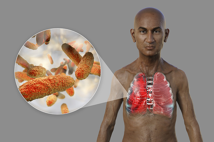 Man with lungs affected by pneumonia, illustration Illustration showing the upper half of a man with transparent skin, revealing the lungs affected by pneumonia, and close up of Klebsiella pneumoniae bacteria., by KATERYNA KON SCIENCE PHOTO LIBRARY