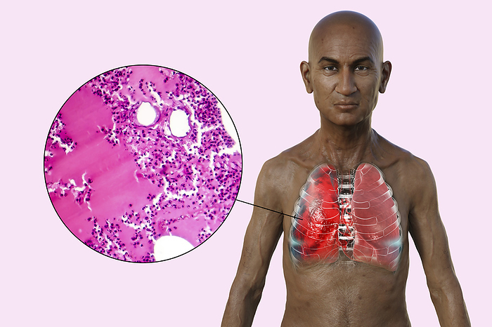Man with lungs affected by pneumonia, illustration Illustration showing the upper half of a man with transparent skin, revealing the lungs affected by pneumonia, along with a micrograph of pneumonia., by KATERYNA KON SCIENCE PHOTO LIBRARY