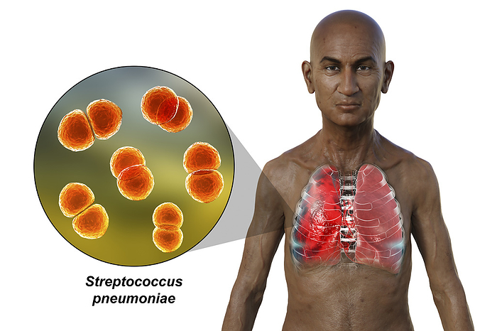 Man with lungs affected by pneumonia, illustration Illustration showing the upper half of a man with transparent skin, revealing the lungs affected by pneumonia, and close up of Streptococcus pneumoniae bacteria., by KATERYNA KON SCIENCE PHOTO LIBRARY