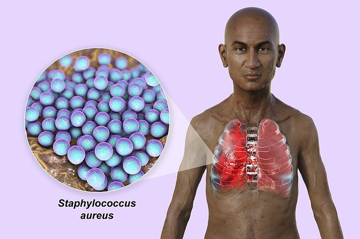 Man with lungs affected by pneumonia, illustration Illustration showing the upper half of a man with transparent skin, revealing the lungs affected by pneumonia, and close up of Staphylococcus aureus bacteria., by KATERYNA KON SCIENCE PHOTO LIBRARY