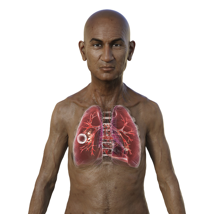 Man with lungs affected by cavernous tuberculosis, illustration Illustration of the upper half of a man with transparent skin, showcasing the lungs affected by cavernous tuberculosis., by KATERYNA KON SCIENCE PHOTO LIBRARY