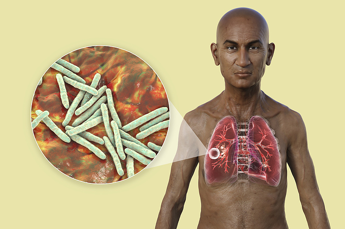 Man with lungs affected by cavernous tuberculosis, illustration Illustration of the upper half of a man with transparent skin, showcasing the lungs affected by cavernous tuberculosis, and close up of Mycobacterium tuberculosis bacteria., by KATERYNA KON SCIENCE PHOTO LIBRARY