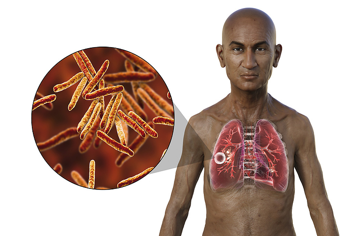 Man with lungs affected by cavernous tuberculosis, illustration Illustration of the upper half of a man with transparent skin, showcasing the lungs affected by cavernous tuberculosis, and close up of Mycobacterium tuberculosis bacteria., by KATERYNA KON SCIENCE PHOTO LIBRARY