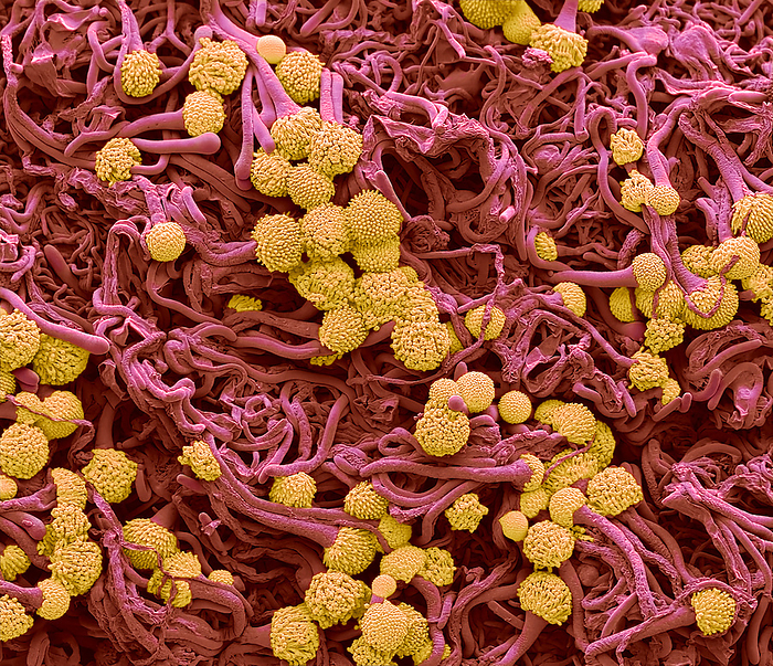 Drug resistant aspergillus, SEM Drug resistant aspergillus. Coloured scanning electron micrograph  SEM  of developing fruiting bodies  conidiophores  of azole resistant aspergillus fumigate. A. fumigatus can cause an invasive life threatening infection, called aspergillosis, in people who have weakened immune systems or have had transplants. Patients with severe cases of respiratory infections such as influenza or SARS CoV 2 have also developed aspergillosis. Triazole antifungal drugs, commonly called azoles, are the primary treatment for aspergillosis. Azole resistant A. fumigatus infections are difficult to treat, and these patients are up to 33  more likely to die than patients with infections that can be treated with azoles. Magnification: x 600 when printed at 10cm wide. Specimen courtesy of Darius Armstrong James Professor of Infectious Diseases and Medical Mycology. Department of Microbiology, Imperial College, by STEVE GSCHMEISSNER SCIENCE PHOTO LIBRARY