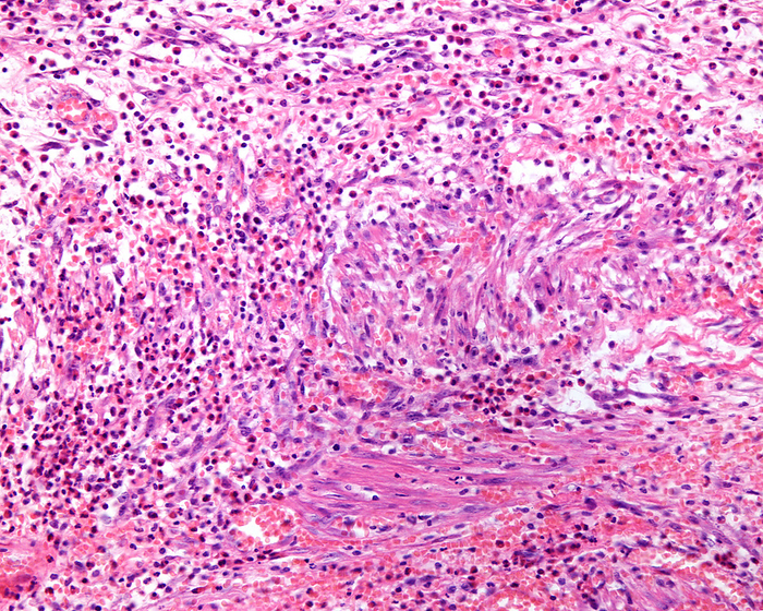 Gangrenous cholecystitis, light micrograph Gangrenous cholecystitis, light micrograph. Cholecystitis is inflammation of the gallbladder. Gangrenous, or necrotising, cholecystitis is a severe advanced form of acute cholecystitis and the most common complication. The micrograph shows a thickened gallbladder wall with severe inflammation and necrosis. Gallbladder epithelium is at top., by JOSE CALVO   SCIENCE PHOTO LIBRARY