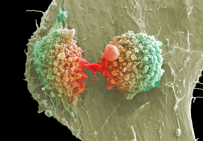 Cervical cancer cells dividing, SEM Cervical cancer cells dividing, colored scanning electron micrograph  SEM . The cervix is the lower part of the womb, also called the neck of the womb, and comprises part of the woman   reproductive system. Cervical cancer is more common in younger women and one of the main causes is a persistent infection of certain types of the human papilloma virus  HPV . In this image the central cells are undergoing cytokinesis, which is the physical process of cell division that divides the parental cell into two daughter cells. Cancer cells often divide and multiply uncontrollably, which can lead to the formation of tumours. The midbody is organised by a set of microtubules and its main function is to localise the site of natural detachment  abstinence . The dividing cells are also displaying blebbing. Blebbing may occur for a number of different reasons including during Blebbing may occur for a number of different reasons including during apoptosis, if a cell is undergoing physical or chemical stress but it also has important functions in cellular processes such as cell division and cell locomotion playing a role in cell surface. locomotion playing a role in cell migration Magnification: x3200 when printed at 10cm wide. by ANNE E. WESTON SCIENCE PHOTO LIBRARY