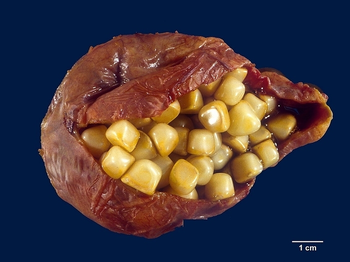 Gallstones Multifaceted cholesterol gallstones in a gallbladder. Gallstones cause significant morbidity worldwide. They are responsible for more than 95  of biliary tract diseases. The incidence of gallstones is strikingly high in the native populations of North and South America  60 80  , presumably under genetic influences. In the US, 10 20  of adults have gallstone disease with a strong female predilection. In the Western countries, gallstones are predominantly cholesterol type. In Asia and Africa, they are mainly pigment type and associated with chronic haemolysis or biliary tract infections. Cholesterol stones can be small or large, single or multiple, round to ovoid, and pale yellow in colour. Pure cholesterol stones  100  cholesterol monohydrate  have a golden yellow colour, whereas mixed cholesterol stones are darker, greyish yellow to brown due to increasing amounts of calcium carbonate, phosphates, and bilirubin. Cholesterol stones have a finely granular, hard external surface and a radiating crystalline or laminated interior. Facets develop when multiple stones form and grow within a confined space., by WEBPATHOLOGY SCIENCE PHOTO LIBRARY