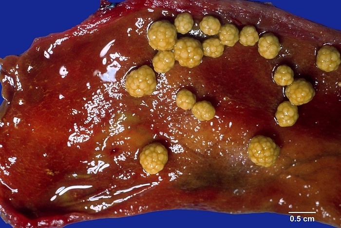 Gallstones Multiple cholesterol stones in an opened gallbladder. Gallstones cause significant morbidity worldwide. They are responsible for more than 95  of biliary tract diseases. The incidence of gallstones is strikingly high in the native populations of North and South America  60 80  , presumably under genetic influences. In the US, 10 20  of adults have gallstone disease with a strong female predilection. In the Western countries, gallstones are predominantly cholesterol type. In Asia and Africa, they are mainly pigment type and associated with chronic haemolysis or biliary tract infections. Cholesterol stones can be small or large, single or multiple, round to ovoid, and pale yellow in colour. Pure cholesterol stones  100  cholesterol monohydrate  have a golden yellow colour, whereas mixed cholesterol stones are darker, greyish yellow to brown due to increasing amounts of calcium carbonate, phosphates, and bilirubin. Cholesterol stones have a finely granular, hard external surface and a radiating crystalline or laminated interior. Facets develop when multiple stones form and grow within a confined space., by WEBPATHOLOGY SCIENCE PHOTO LIBRARY