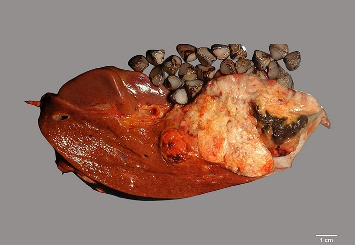 Gallbladder cancer Gross specimen showing direct spread of gallbladder cancer to the liver. The remnant of gallbladder is seen on the right. It is surrounded by fleshy, yellow white tumour extending into the liver. Numerous gallstones were also present in the gallbladder. Gallbladder carcinoma  cancer  is a disease of older adults and is more common in females. It is more prevalent in Latin America and some parts of Asia as compared to the United States and Europe. Some of the risk factors of gallbladder cancer are similar to those for gallstones., by WEBPATHOLOGY SCIENCE PHOTO LIBRARY