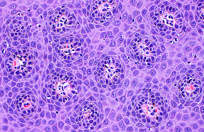 Skin epidermis papilla cross sections, light micrograph Light micrograph of skin papilla cross sections. The papilla are finger like projections of the skin epidermis into the underlying dermis. Here, they appear as circles since they are cut in horizontal cross sections. The cells making up the epidermis are squamous cells with polygonal borders and round nuclei. Haematoxylin and eosin stained tissue section. Magnification: 200x when printed at 10cm., by ZIAD M. EL ZAATARI SCIENCE PHOTO LIBRARY