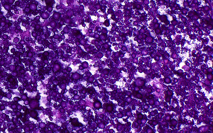 Calcium phosphate calcifications, light micrograph Light micrograph of calcium phosphate type calcifications. The calcifications, filling the field of view in this image, stain dark purple. Ways these calcifications can form in human tissues include following injury  dystrophic calcification  or due to high levels of calcium in the blood  metastatic calcification . Haematoxylin and eosin stained tissue section. Magnification: 400x when printed at 10cm., by ZIAD M. EL ZAATARI SCIENCE PHOTO LIBRARY