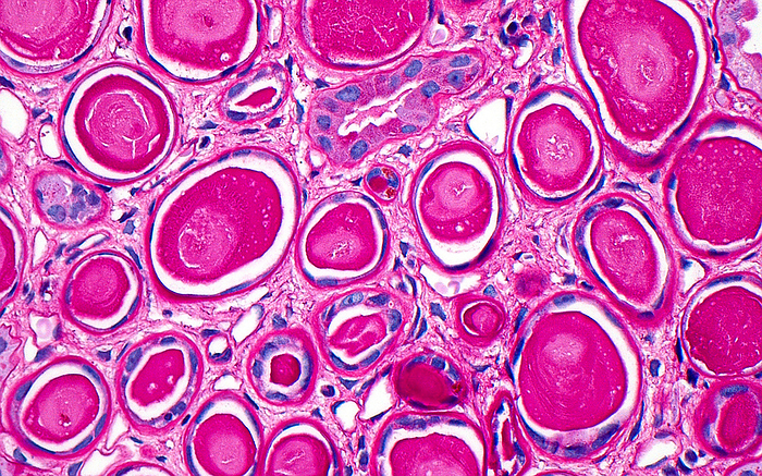 Atrophic renal tubules, light micrograph Light micrograph of atrophic thyroidized renal tubules. Atrophic kidney tubules occur in response to chronic injury. The tubules are filled with dense cast material, which makes them resemble thyroid follicles, hence the term   hyroidisation   Magnification: 400x when printed at 10cm. by ZIAD M. EL ZAATARI SCIENCE PHOTO LIBRARY