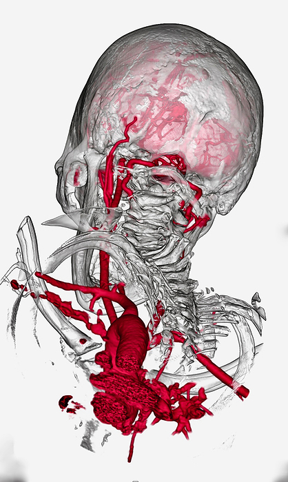 Brain and neck arteries, CT angiogram Coloured 3D computed tomography  CT  angiogram showing the arteries  red  of the brain and neck from below and behind. Just below centre is the aortic arch, where the body s main artery, the aorta, leaves the heart. The carotid arteries branch from the aortic arch and then further divide into cerebral arteries which supply the brain with oxygenated blood., by VSEVOLOD ZVIRYK SCIENCE PHOTO LIBRARY