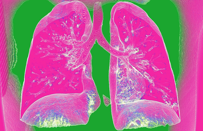 Lungs, CT scan Coloured 3D computed tomography  CT  scan of the lungs  pink  from the front. The trachea  windpipe, top centre  can be seen branching into the bronchi, which further branch into bronchioles. The lungs are the site of gaseous exchange, where carbon dioxide is removed from the blood and oxygen is added., by VSEVOLOD ZVIRYK SCIENCE PHOTO LIBRARY