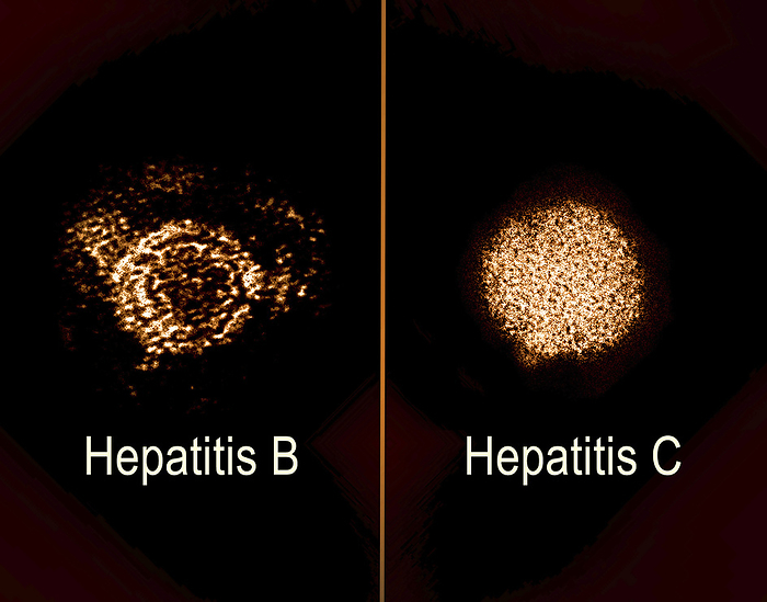 Hepatitis B and C, TEM micrographs Coloured transmission electron micrographs  TEMs  of hepatitis B  hep B  and hepatitis C  hep C  virions side by side. Both viruses are spread primarily from blood to blood contact, but can be spread sexually, and both cause infections of the liver. Hepatitis in both forms is typically initially symptomless, but can cause serious chronic liver damage, including cirrhosis and cancer. There is a vaccine for hep B, but no cure. There is a cure for hep C that is 90  effective, but no vaccine., by CDC, The Rockefeller University, NIAID, NIH SCIENCE PHOTO LIBRARY