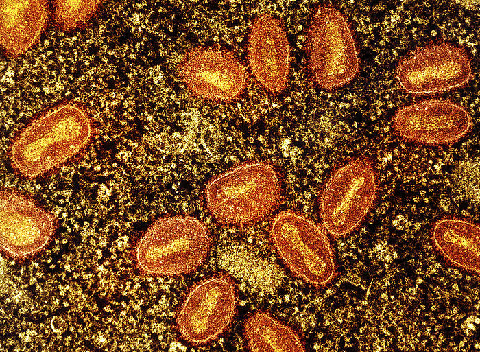 Mpox virus particles, TEM Coloured transmission electron micrograph  TEM  of mpox  previously monkeypox  virus particles  orange  within an infected cell  yellow . In humans mpox infection causes fever, fatigue, body aches, swollen glands and a rash of fluid filled blisters. Transmission can occur through direct contact with infectious skin or other lesions, bites or scratches from infected animals, or indirectly through contact with contaminated objects. The mpox virus was first discovered in 1958 in two outbreaks of a pox like disease among colonies of research monkeys, though small mammals such as rodents are believed to be the natural hosts. The first human case was recorded in 1970 in the Democratic Republic of the Congo, and it is endemic in central and western Africa. Most people recover from mpox infection within 2 4 weeks, and a vaccine is available., by NIAID SCIENCE PHOTO LIBRARY