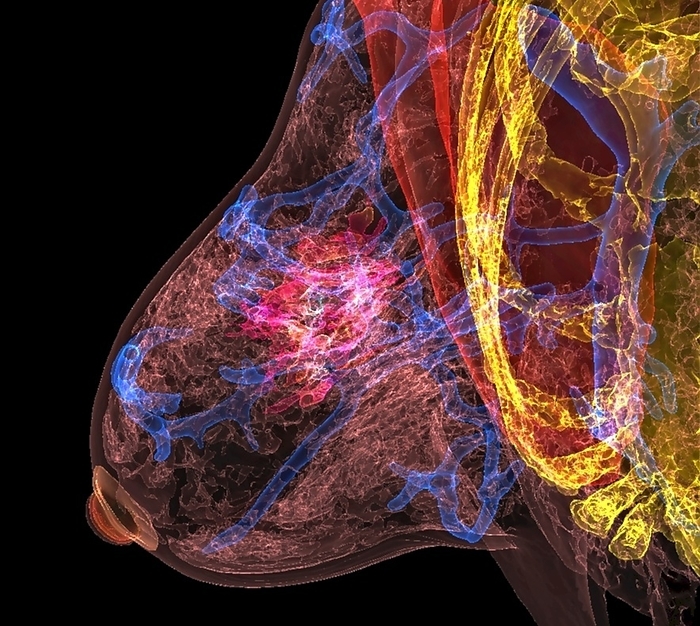 Breast cancer, combined MRI and CT scans Coloured 3D combined computed tomography  CT  and magnetic resonance imaging  MRI  scans showing a tumour  pink  in a breast, extending to the pectoralis muscle  red . Breast cancer is the uncontrolled growth of irregular breast cells. Breast cancer can present as a breast lump or thickening  often painless , a change in the size or shape of the breast, changes in the appearance of the nipple or areola, or an abnormal fluid discharge from the nipple. Treatment options include combinations of surgery, radiotherapy and chemotherapy., by K H FUNG SCIENCE PHOTO LIBRARY