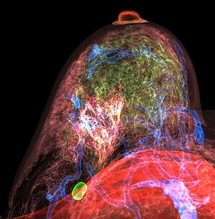 Breast cancer, combined MRI and CT scans Coloured 3D combined computed tomography  CT  and magnetic resonance imaging  MRI  scans showing a tumour  pink  in a breast, extending to the pectoralis muscle  red . A lymph node  bright green  is also visible. Breast cancer is the uncontrolled growth of irregular breast cells. Breast cancer can present as a breast lump or thickening  often painless , a change in the size or shape of the breast, changes in the appearance of the nipple or areola, or an abnormal fluid discharge from the nipple. Treatment options include combinations of surgery, radiotherapy and chemotherapy., by K H FUNG SCIENCE PHOTO LIBRARY