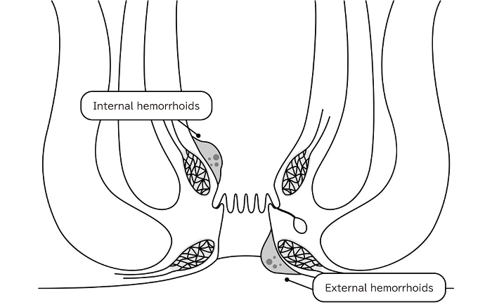 Diseases of the anus, hemorrhoids and warts Illustrations, cross-sectional views