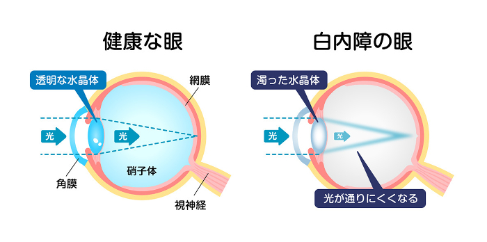 Cataract eye Structure and causes Vector illustration