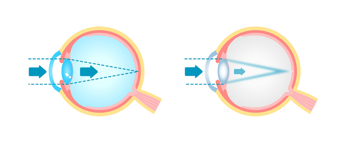 Cataract eye Structure and causes Vector illustration