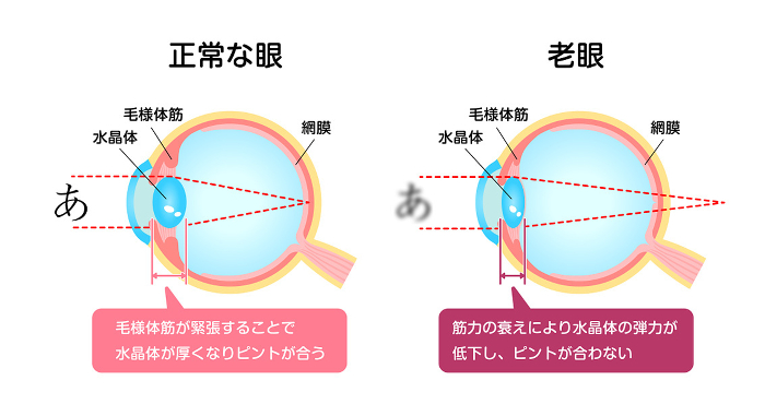 Normal eye and presbyopia Comparison vector illustration