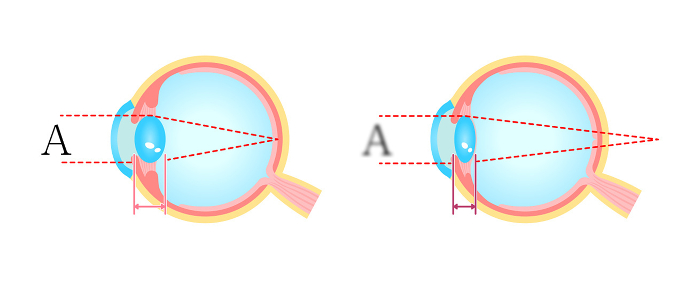 Normal eye and presbyopia Comparison vector illustration