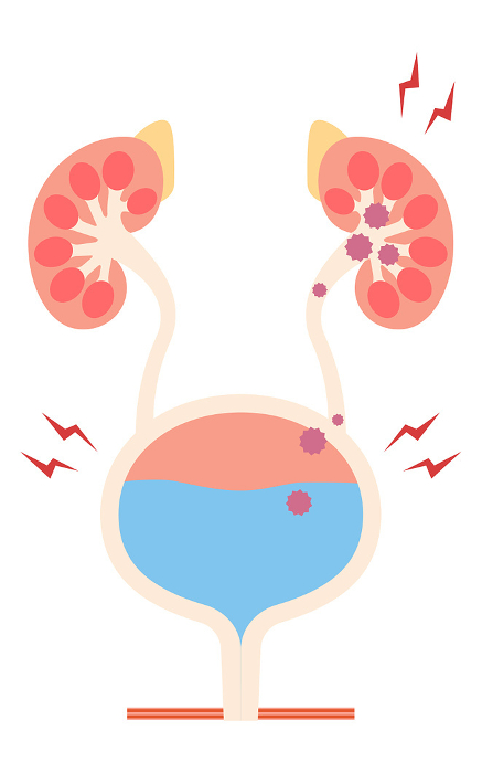 Medical illustration of pyelonephritis, the backflow of bacteria from the bladder to the kidneys