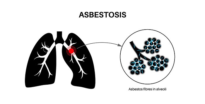 Asbestosis lung disease, illustration Asbestosis lung disease, illustration., by PIKOVIT   SCIENCE PHOTO LIBRARY