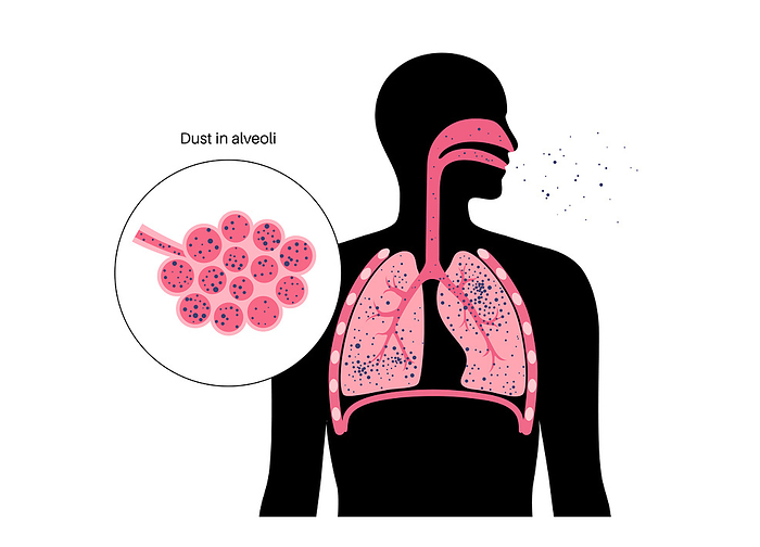 Pneumoconiosis lung disease, illustration Pneumoconiosis lung disease, illustration., by PIKOVIT   SCIENCE PHOTO LIBRARY