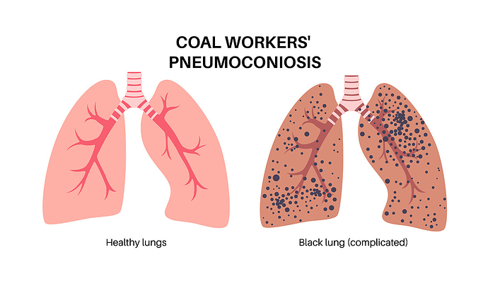 Coal workers disease, illustration Coal workers disease, illustration., by PIKOVIT   SCIENCE PHOTO LIBRARY