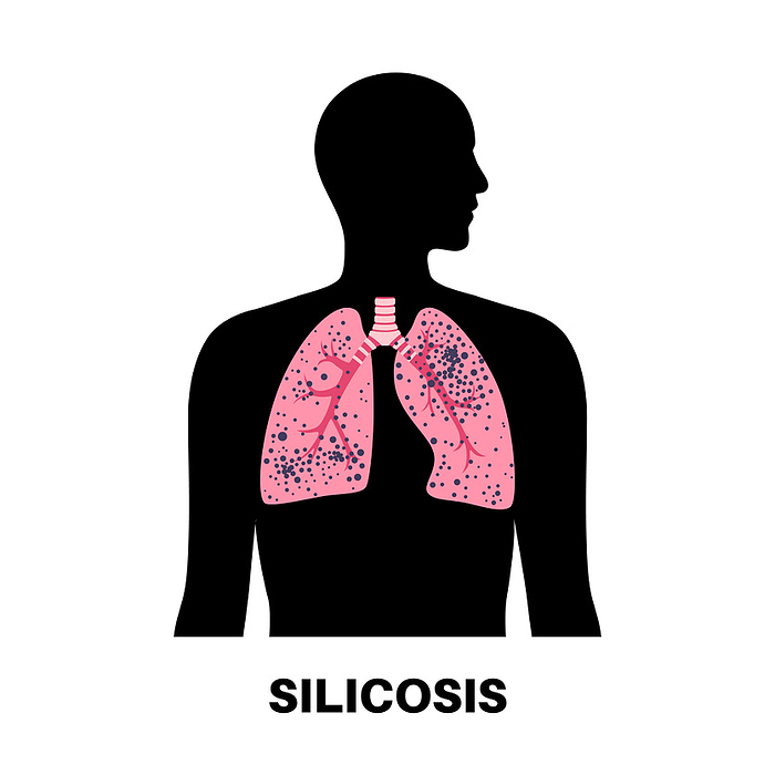 Silicosis dust in lung, illustration Silicosis dust in lung, illustration., by PIKOVIT   SCIENCE PHOTO LIBRARY
