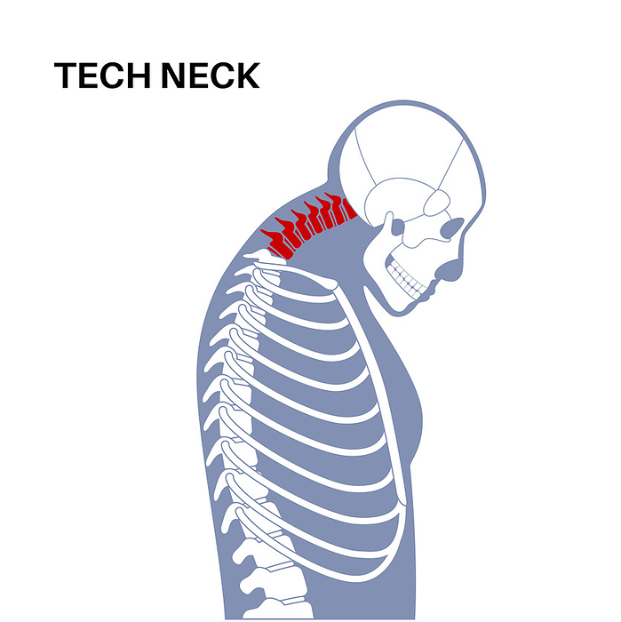 Neck vertebrae deformity, illustration Neck vertebrae deformity, illustration., by PIKOVIT   SCIENCE PHOTO LIBRARY